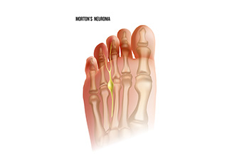 Flat Foot and High Arches Treatment - Penn Medicine