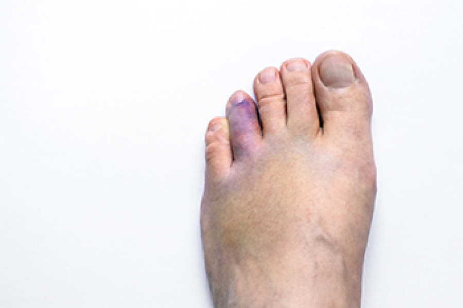 signs-of-a-broken-big-toe-canyon-oaks-podiatry-fresno-podiatrist